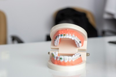 Braces colors on teeth